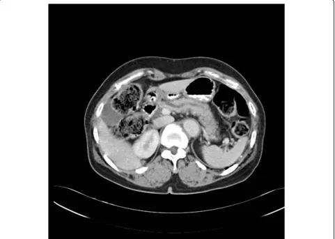 Figure 1 Abdominal CT finding. The pancreatic duct was diffusely dilated without a definite obstructive mass lesion.