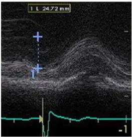 Fig - 04. M - mode measurement of the tricuspid annulus planar 