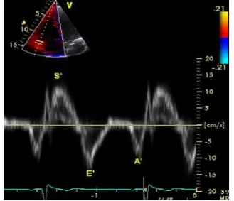Fig - 08. Tissue Doppler imaging of the lateral tricuspid annulus to 