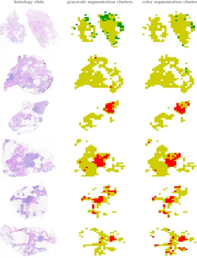 Figure 11Identification of the normal-specific (shown in green), cancer-specific (shown in red), and non-specific (shown in yellow) few image blocks in normal histology slides as specific to cancer