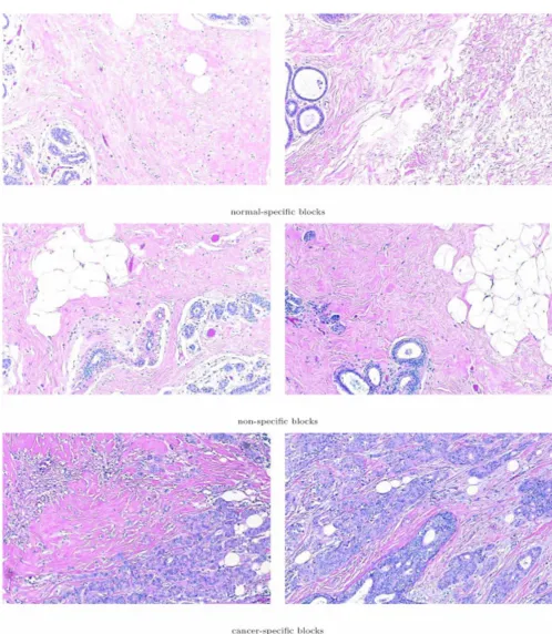 Figure 12neously based on texture parameters obtained from grayscale and color tissue segmentation algorithmsSample image blocks of normal-specific, cancer-specific, and non-specific histological appearance clusters as identified simulta-Sample image blocks of normal-specific, cancer-specific, and non-specific histological appearance clusters as identified simulta-neously based on texture parameters obtained from grayscale and color tissue segmentation algorithms.