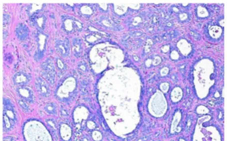 Figure 4Histology image segmentation into chromatin-rich, stromal, and unstained regions using color informationrich and stromal regions are identified in the second step using a modified 2-cluster unstained regions are separated from the chromatin-rich an