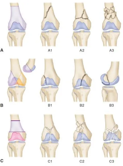 Fig 10.Classification of fractures distal femur by Muller et al 