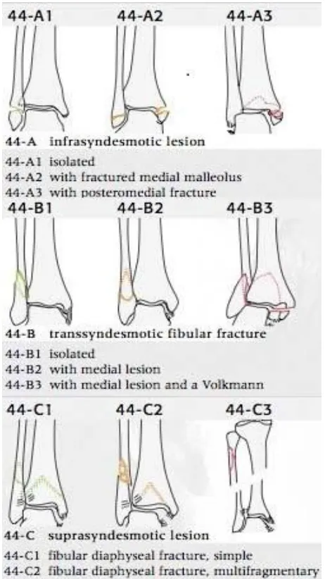 Figure6. AO classification system – distal fibula fractures 