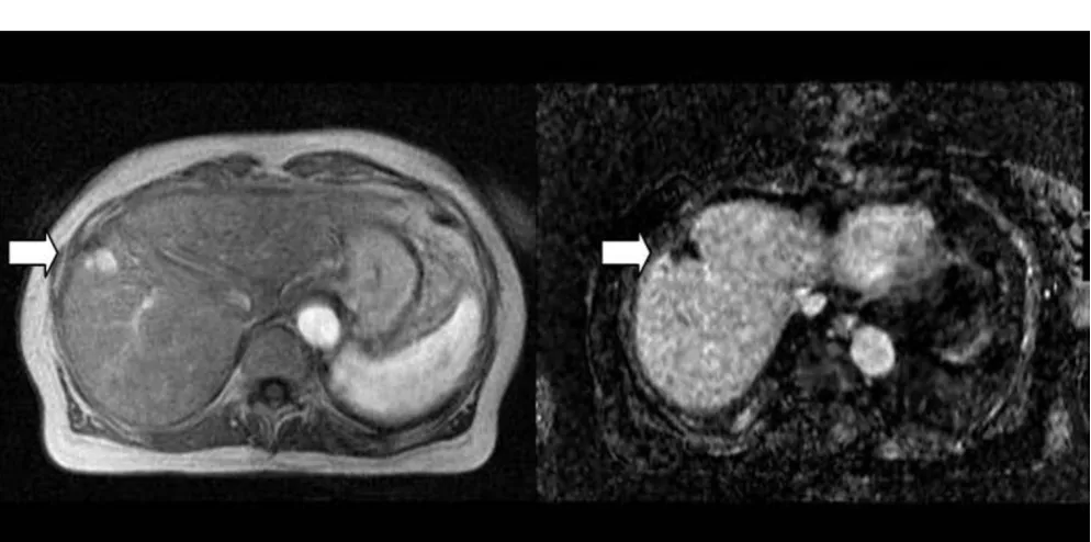 Figure 3Comparison between subtraction imagesFinally, the high signal intensity artifact on the lateral and anterior margins of the liver disappears after registration (arrows in Comparison between subtraction images