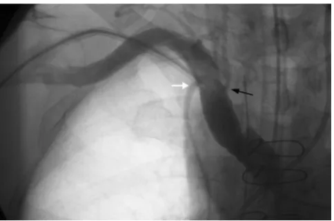 Figure 2Contrast was injected via the 8.5 F sheathContrast was injected via the 8.5 F sheath