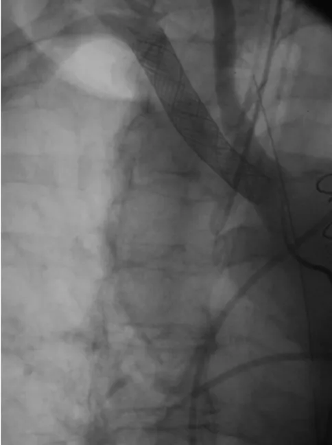 Figure 4Subclavian artery angiography in RAO 25 degree obliquitySubclavian artery angiography in RAO 25 degree obliquity