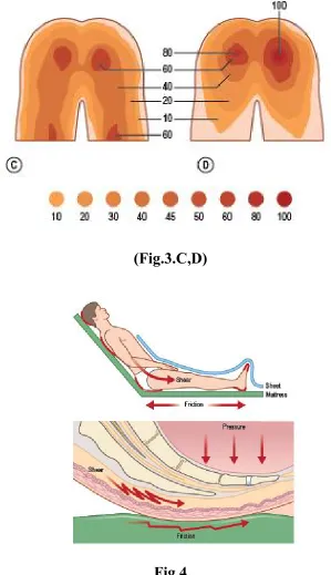 Fig.4 The other  forces which contribute to develope pressure sore are shear and 