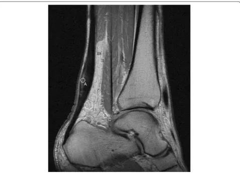 Figure 1 Proton density weighted turbo spin-echo image of the right Achilles tendon prior to eccentric training in a 45-year-old manwith chronic Achilles tendinosis