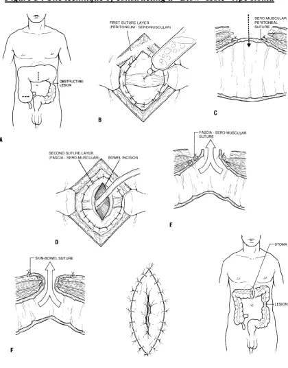 Figure 3 : The technique of constructing a “Blow- Hole” type stoma