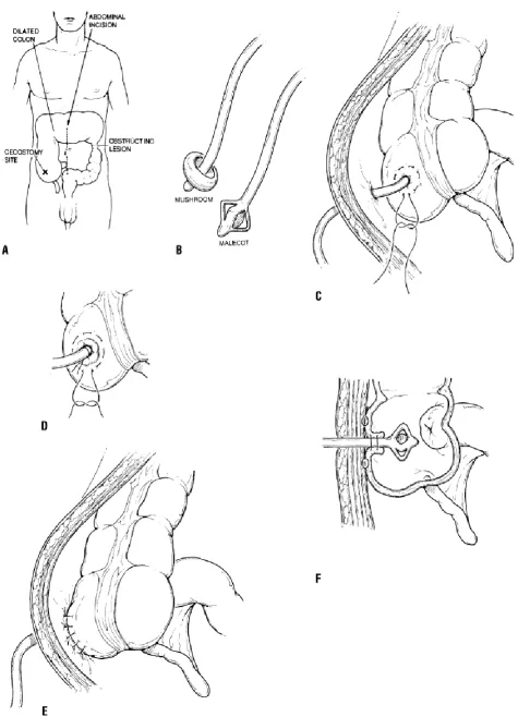 Figure 4 : The technique of constructing a tube type cecostomy 