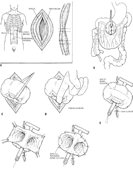 Figure 5 : The technique of constructing a loop transverse colostomy 