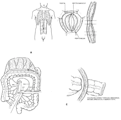 Figure 6 : The technique of constructing an end colostomy