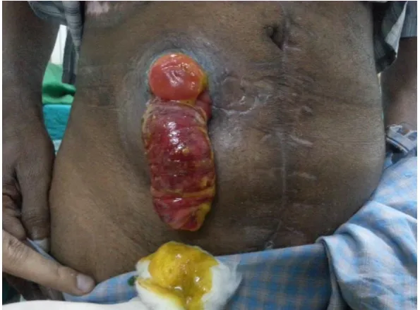 Figure 7 : A rare occurrence of a stomal prolapse with a parastomal 