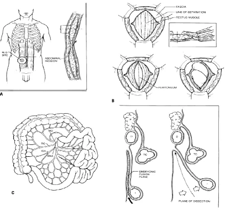 Figure 8 : The technique of constructing an end ileostomy