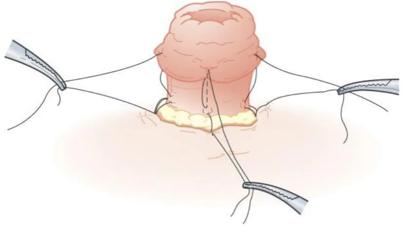Figure 9: The “Tripartite” fixation 