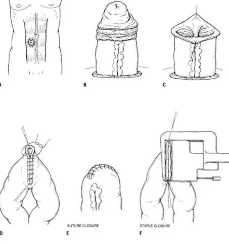 Figure 11: The technique of closure of a loop ileostomy 