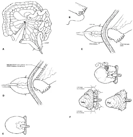 Figure 12: The technique of construction of a loop- end stoma 