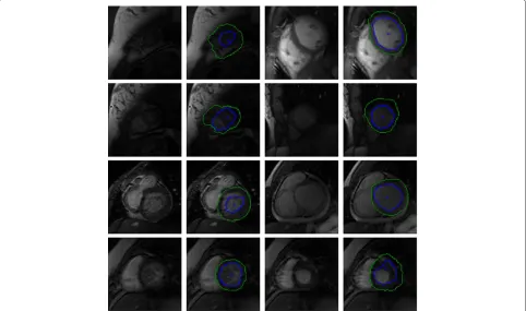 Figure 11 Bad quality York automatic segmentations. Selection of incorrectly segmented contours (inner contour is blue and outer is green)inferred from a testing set