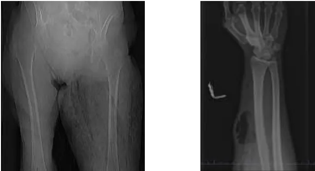 Fig.4 Plain Radiographs showing subcutaneous gas 