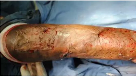 Fig.7 Raw area right leg after surgical debridement 