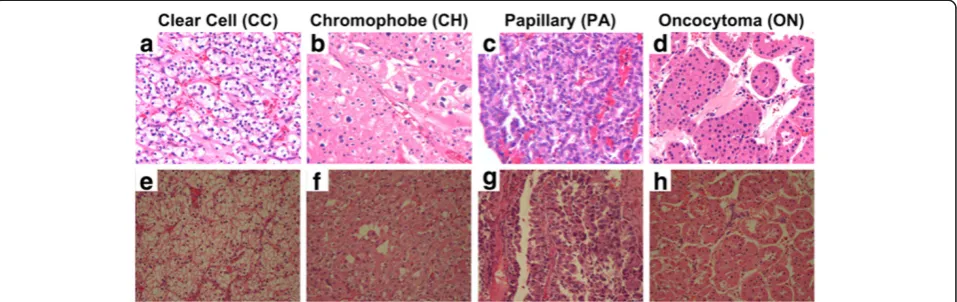 Figure 1 Example images of four H&E stained histological renal tumor subtypes in datasets A (a-d) and B (e-h).renal ( Among four subtypes,three are renal cell carcinoma (RCC) subtypes: (a and e) clear cell, (b and f) chromophobe, and (c and g) papillary