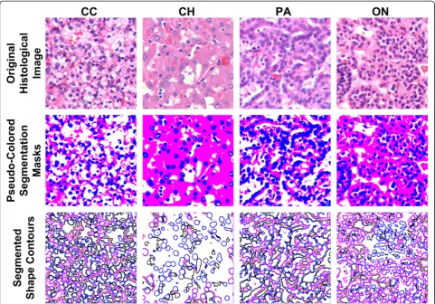 Figure 4 Color segmentation results and shape contours in three masks for four renal tumor subtypes: clear cell (CC), chromophobe(CH), papillary (PA), and oncocytoma (ON)