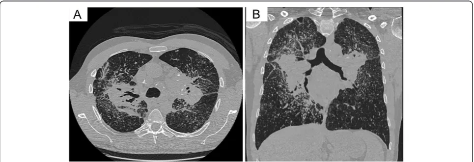 Figure 1 A frontal chest x-ray showing changes consistentsarcoidosis. There is bilateral bulky hilar and paratracheallymphadenopathy together with extensive, confluent reticulonodularopacities with a characteristic distribution in the mid and upper zones.