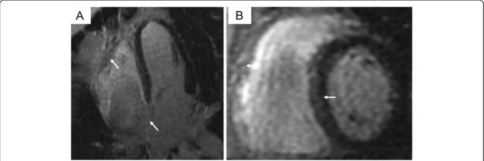 Figure 5 Delayed enhancement cardiac magnetic resonance images in the four-chamber (A) and short axis (B) image plane