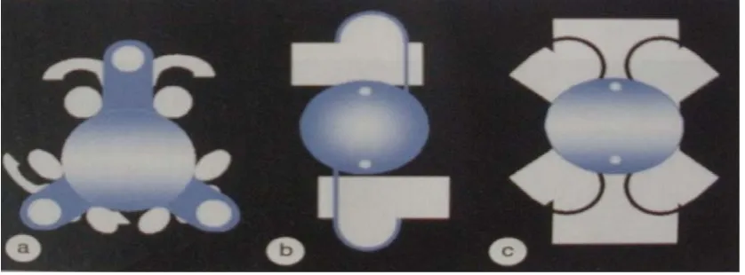 Figure 17- Schematic representation of implanted PC lenses 