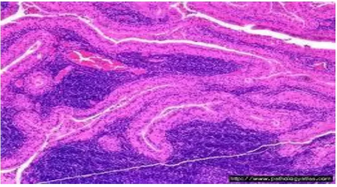 Fig. h)MICROSCOPIC PICTURE OF WARTHIN'S TUMOUR 