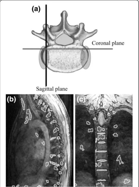 Figure 2 Problematic zone for automatic segmentation.Complementary information is found in different imaging planes.(a) Axial view of vertebra showing orientations of sagittal andcoronal planes