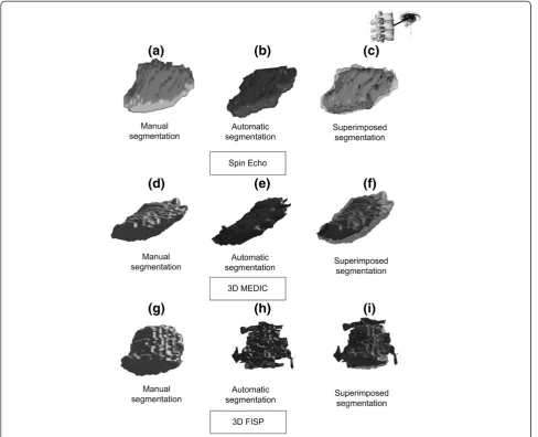 Figure 5 3D reconstruction of intervertebral disks. 3D reconstruction of intervertebral disks obtained with the manual and automaticsegmentation procedures