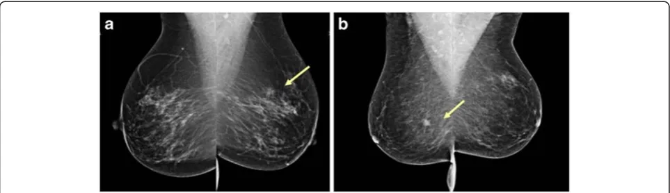 Figure 1 Figure 1a shows a rather hard to detect breast cancer in the left breast (arrow); the right breast is normal