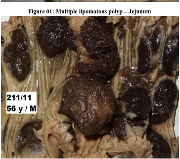 Figure 02: Malignant melanoma deposits – Jejunum showing multiple localized polypoid lesions  