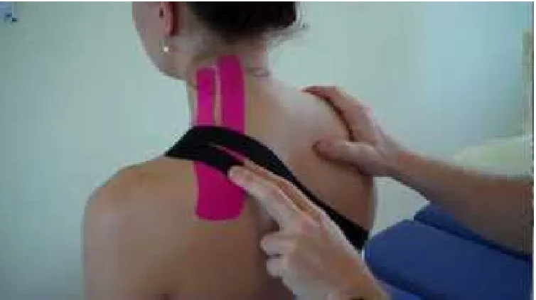Figure -2 shows levator scapulae trigger point 