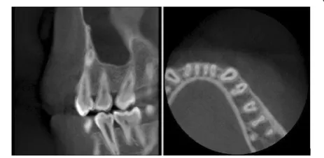 Figure 2 Cross-sectional CBCT image of mandibular first premolar with a clearly distinguished C-shaped configuration