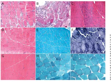 Figure 3 Myopathologic changes in patients with limb-girdle muscle weakness (top row, A–C), myalgia, and exerciseintolerance (middle row, D–F) and in asymptomatic patients (bottom row, G–I)