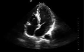 Figure 4: ultrasound of a heart 