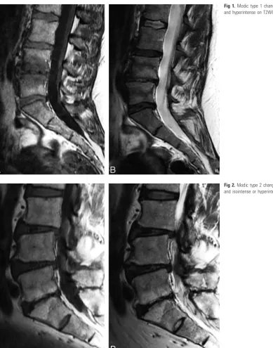 Fig 1. Modic type 1 changes are hypointense on T1WI (A)