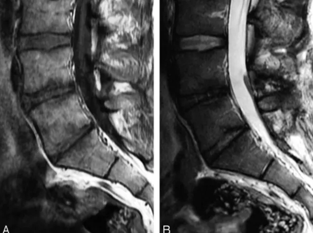 Fig 3. Modic type 3 changes are hypointense on both T1WI