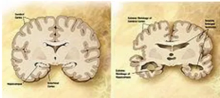 Fig:1.2 Comparison of a normal aged brain (left) and the brain of a person with                     