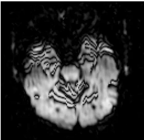 Fig 2. Combined DWI image shows pronounced artifacts at the anterior temporal lobes andaround the superior cerebellar vermis (black lines) due to mechanical vibration.