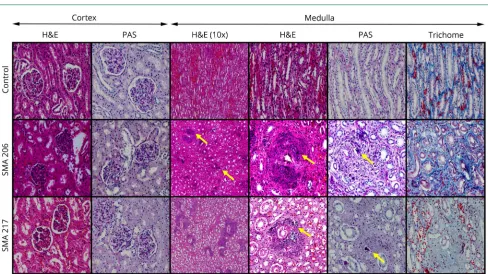 Figure 1 Kidney histopathology in patients with SMA type 1