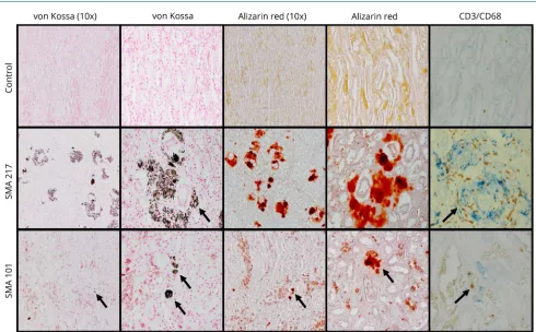Figure 2 Medullary calcifications in patients with SMA type 1