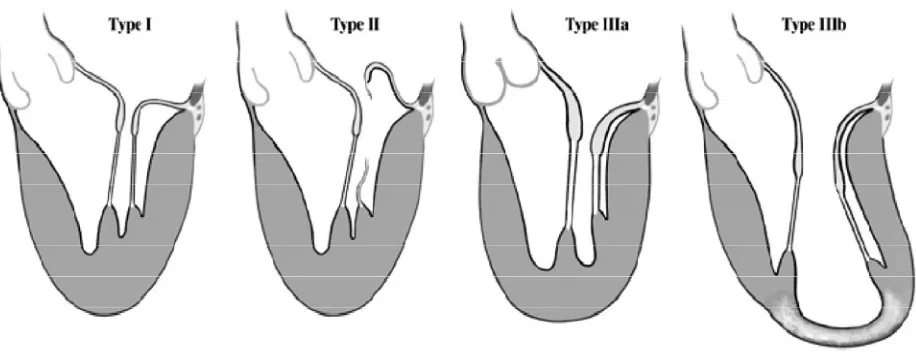 Figure 1: Carpentier’s functional classification of Mitral Regurtitation17 