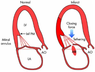 Figure 2: Left figure: Normal coaptation is seen. Right figure: tethering of leaflet 