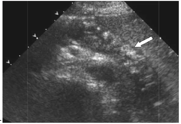Figure  showing showing Hypo echoic gland with multiple punctuate 