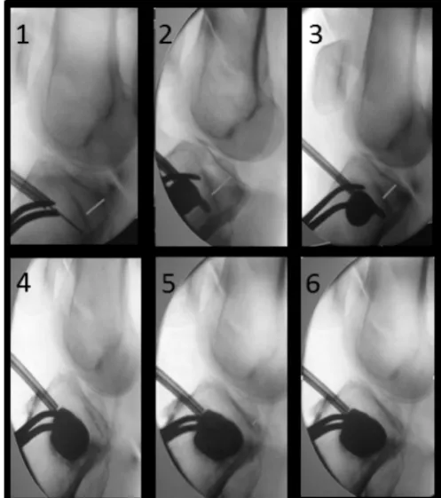 Figure 2 Tuberoplasty entry point (adapted from Hannouche et al13).