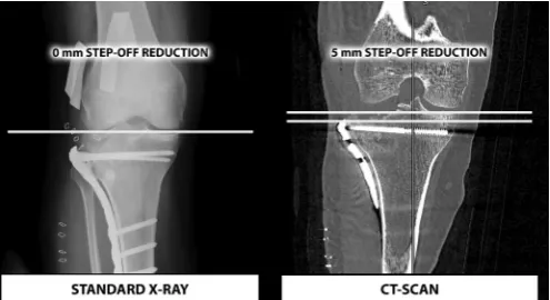 Figure 4 A radiological comparison between standard X-ray and CT scan (adapted from Haller et al22).